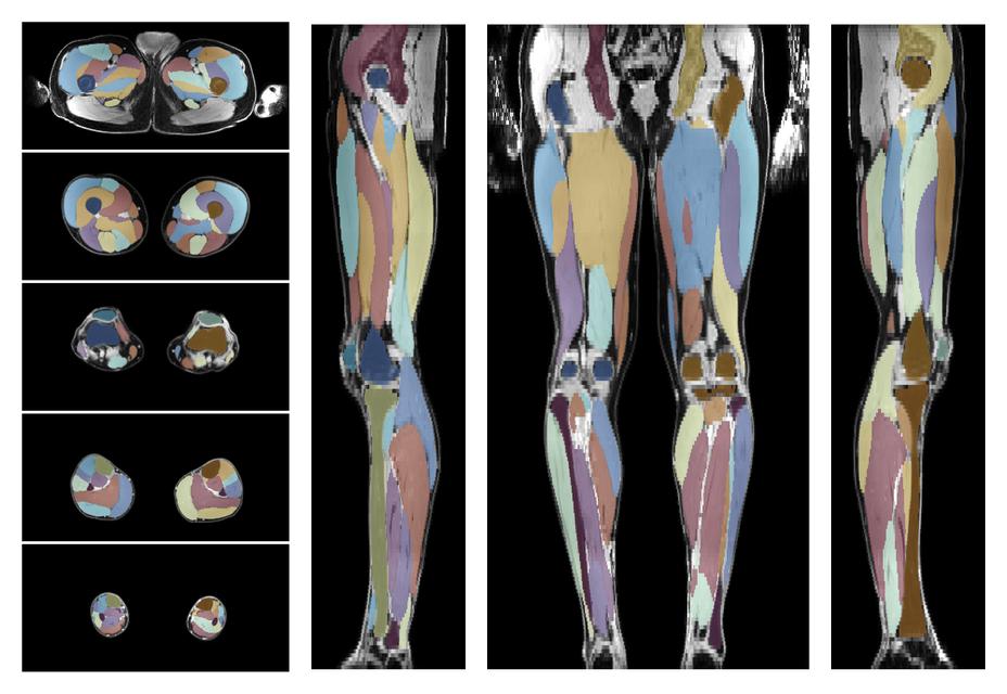 Overlay of automated muscle segmentation labels on dixon water image.